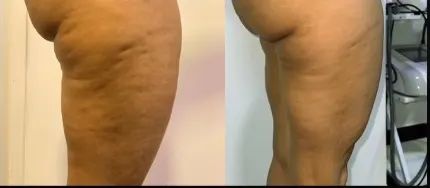 Antes e depois — Celulites e lipedema
