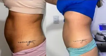 Antes e depois — Diástase