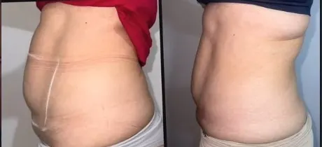 1 semana — hidrolipo e criolipólise