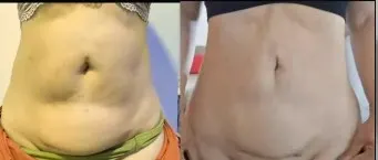 Antes e depois — Pós-operatório